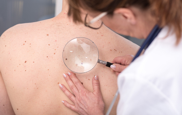 Melanoma: con i farmaci epigenetici l'immunoterapia funziona meglio