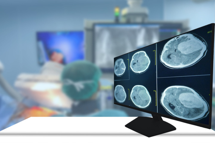 Glioblastoma e Car-T: a che punto siamo?