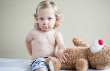 Ecco perchè il vaccino contro il morbillo ci protegge anche da altro