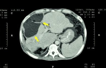 Tumore del pancreas: la prevenzione non è più un miraggio
