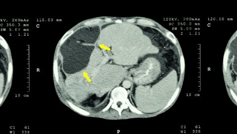 Tumore del pancreas: la prevenzione non è più un miraggio