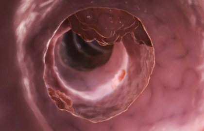 Dai batteri intestinali una risposta al tumore del colon?