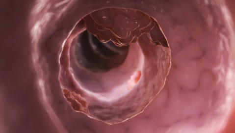 Dai batteri intestinali una risposta al tumore del colon?