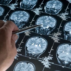 Con La Diagnosi Precoce Fermi L Alzheimer Fondazione Umberto Veronesi