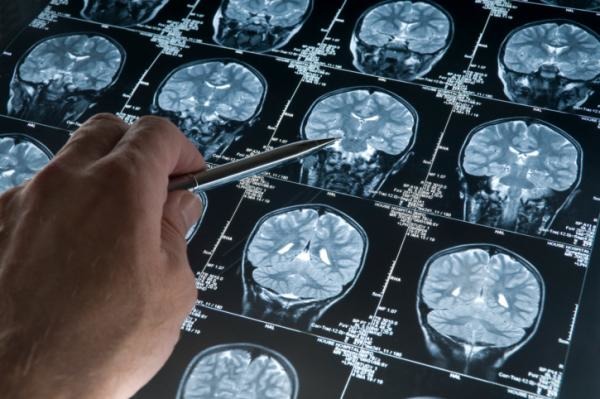 Con la diagnosi precoce fermi l'Alzheimer