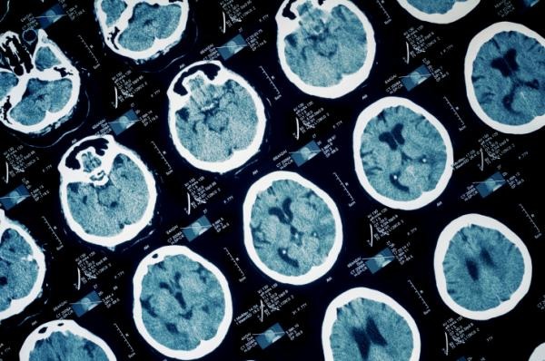 Le prime mosse per scoprire e battere l'ictus