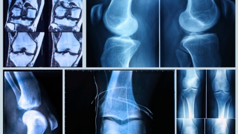 Artroscopia: la metodica che ha rivoluzionato la chirurgia ortopedica