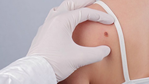 Melanoma, rischi più alti se ci si ammala in gravidanza