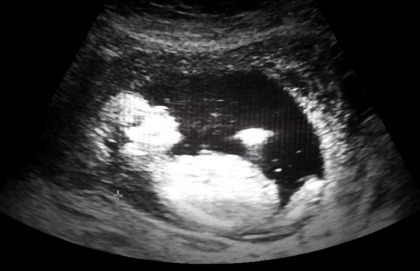 Un figlio dopo le cure per tumore al seno non è più utopia