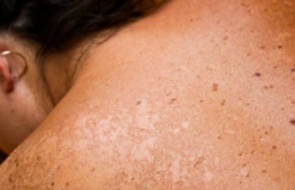 La pelle va protetta dal sole solo durante il periodo estivo?