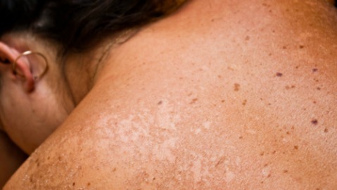 La pelle va protetta dal sole solo durante il periodo estivo?