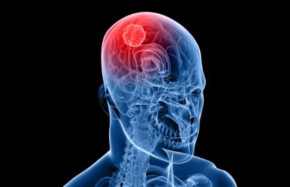 Dalla metformina un’opportunità per combattere il glioblastoma