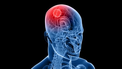 Dalla metformina un’opportunità per combattere il glioblastoma