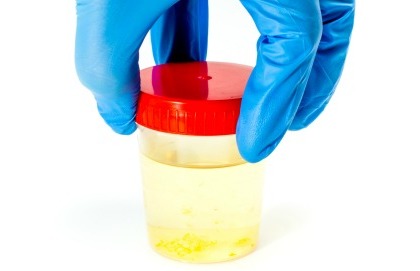 Cosa fare in caso di sangue nelle urine?