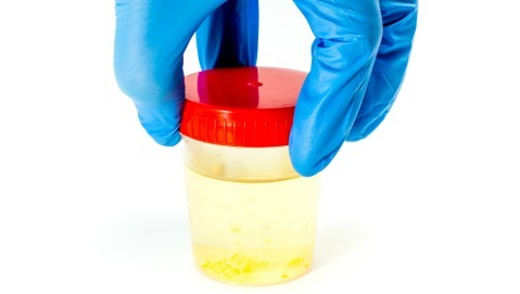 Cosa fare in caso di sangue nelle urine?